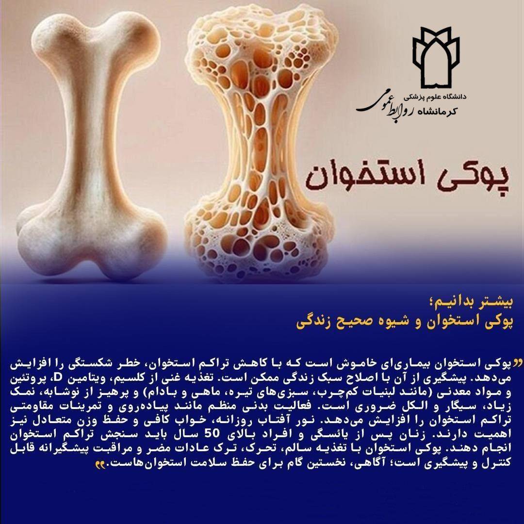 بیماری پوکی استخوان را بیشتر بشناسیم بیماری پوکی استخوان را بیشتر بشناسیم